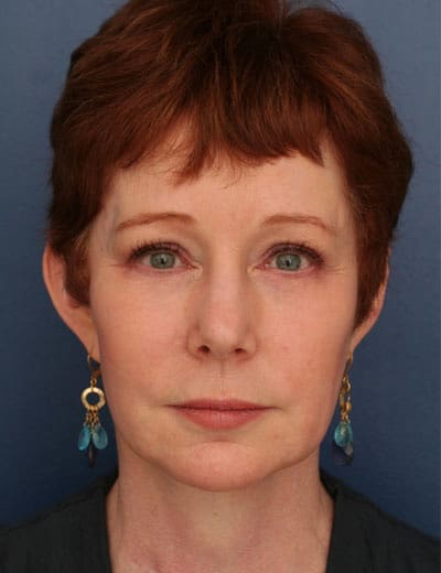 After Image: Facelift - front