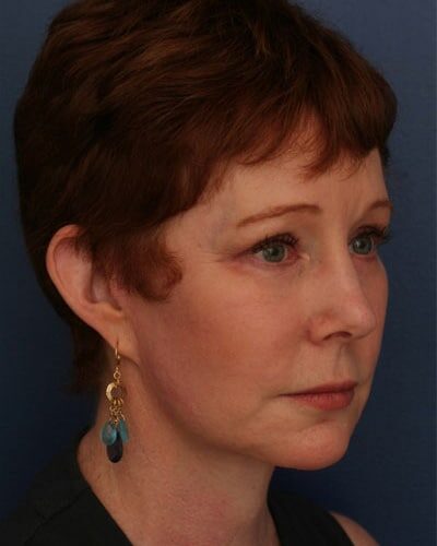 After Image: Facelift - right-front-oblique