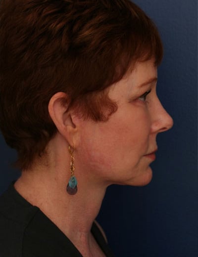 After Image: Facelift - right-side