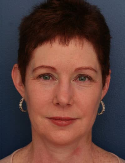 Before Image: Facelift - front