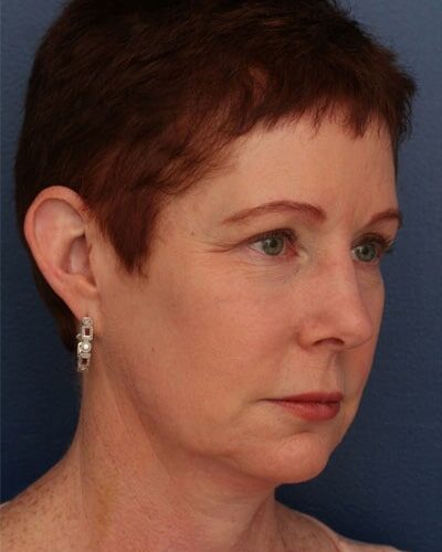 Before Image: Facelift - right-front-oblique