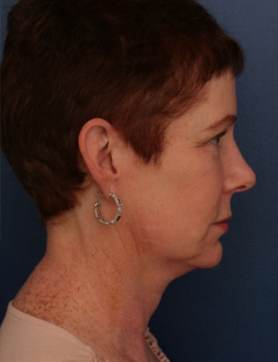 Before Image: Facelift - right-side