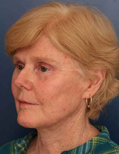 After Image: Facelift - left-front-oblique