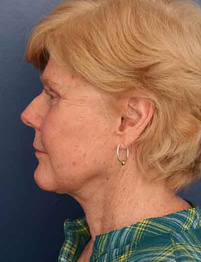 After Image: Facelift - left-side