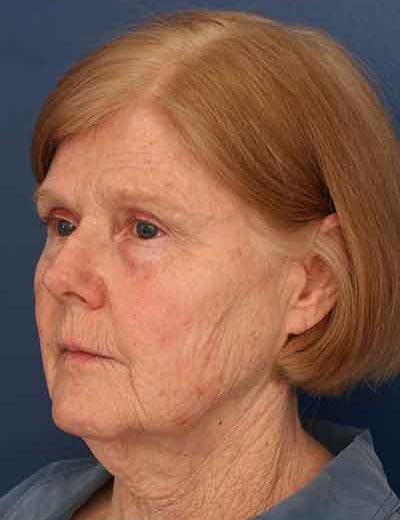 Before Image: Facelift - left-front-oblique