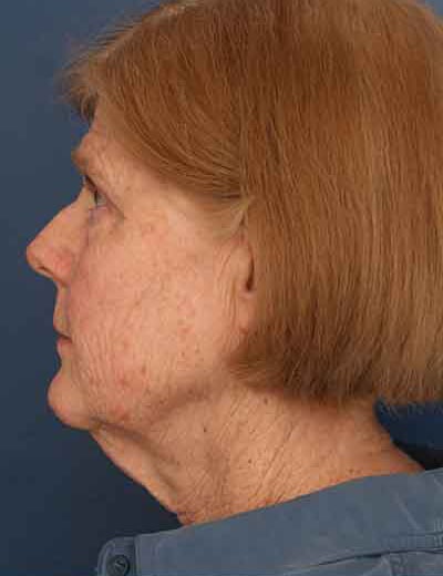 Before Image: Facelift - left-side
