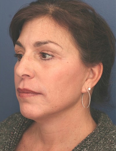 After Image: Facelift - left-front-oblique