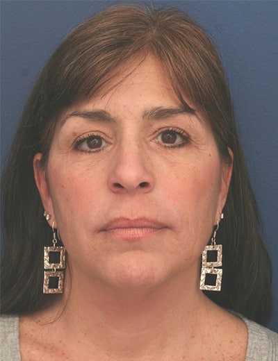 Before Image: Facelift - front