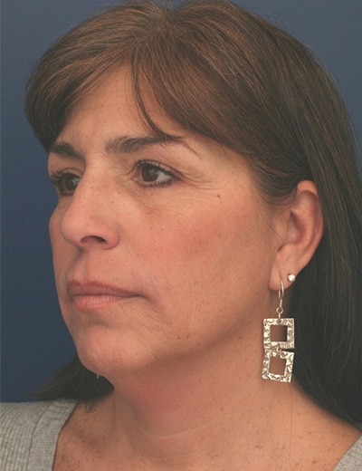 Before Image: Facelift - left-front-oblique