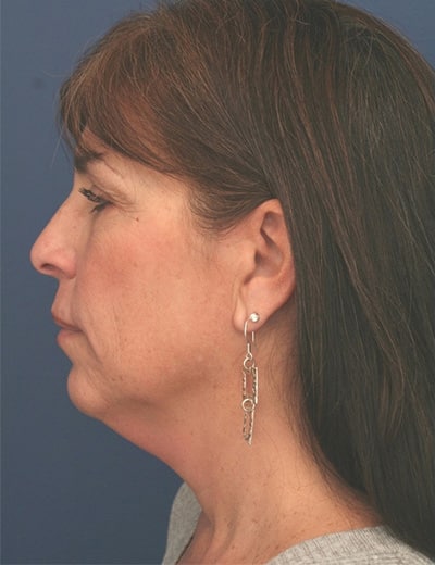 Before Image: Facelift - left-side