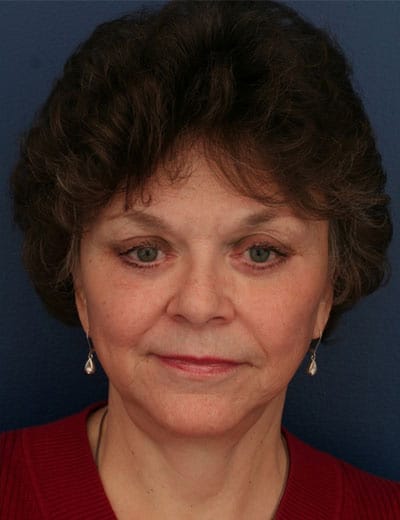 After Image: Facelift - front