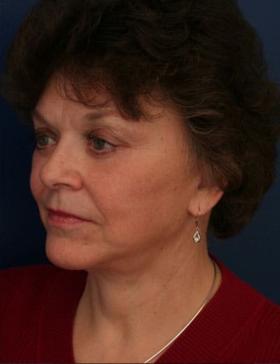 After Image: Facelift - left-front-oblique