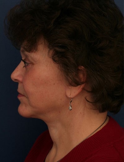 After Image: Facelift - left-side