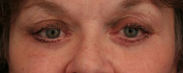 After Image: Facelift - front