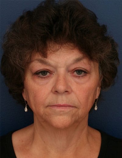 Before Image: Facelift - front