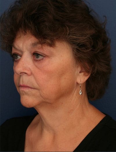 Before Image: Facelift - left-front-oblique