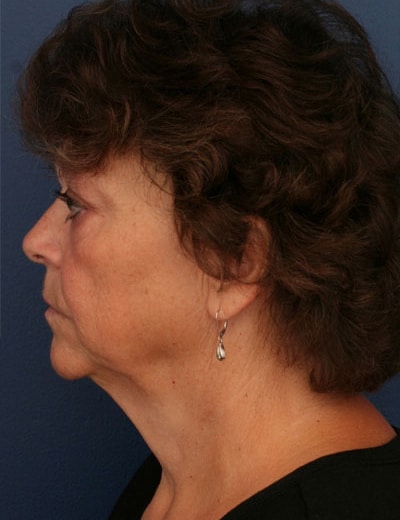 Before Image: Facelift - left-side