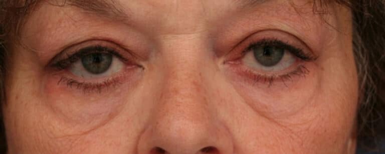 Before Image: Facelift - front
