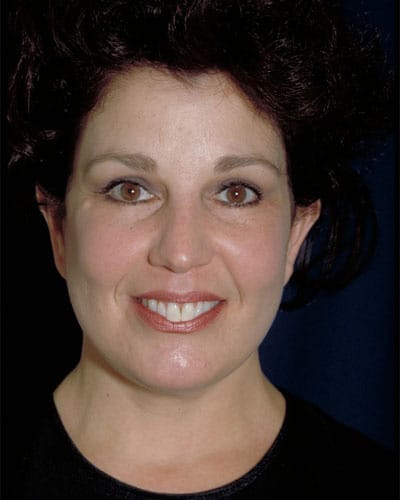 After Image: Facelift - front
