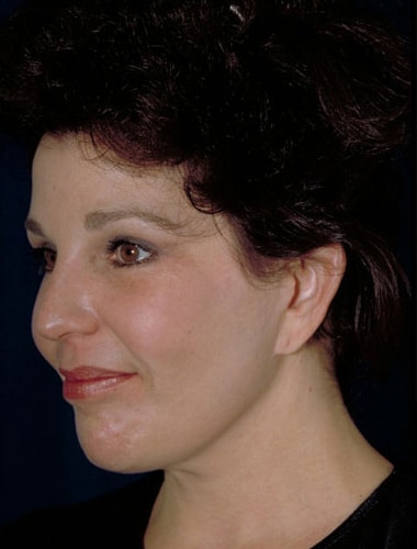 After Image: Facelift - left-front-oblique