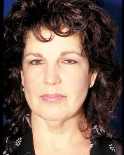 Before Image: Facelift - front