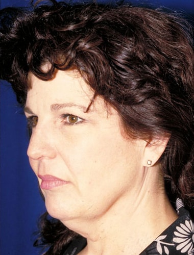 Before Image: Facelift - left-front-oblique