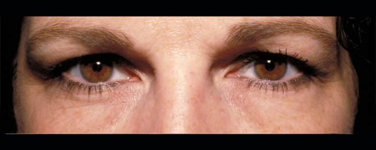Before Image: Facelift - front