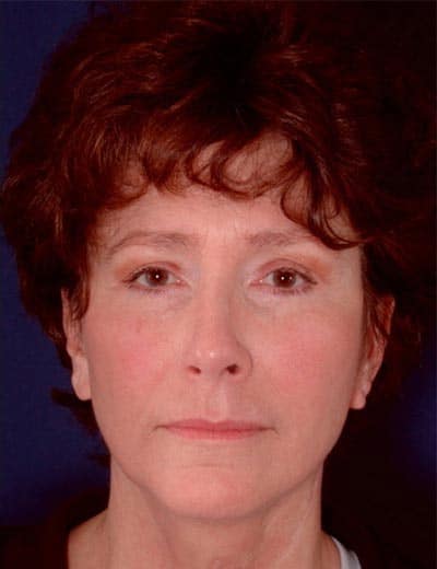 After Image: Facelift - front