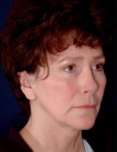 After Image: Facelift - right-front-oblique