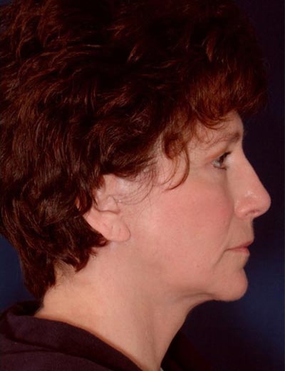 After Image: Facelift - right-side