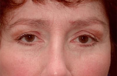 After Image: Facelift - front