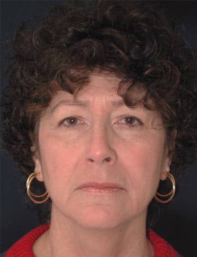 Before Image: Facelift - front