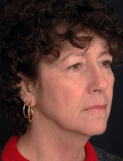 Before Image: Facelift - right-front-oblique