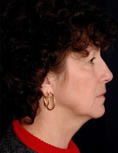 Before Image: Facelift - right-side