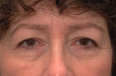 Before Image: Facelift - front
