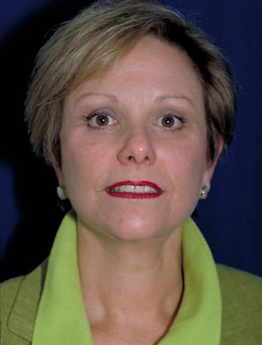 After Image: Facelift - front