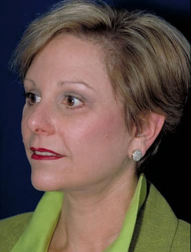After Image: Facelift - left-front-oblique