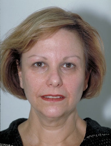 Before Image: Facelift - front