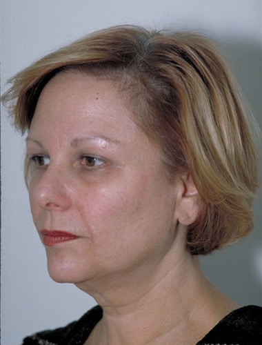 Before Image: Facelift - left-front-oblique