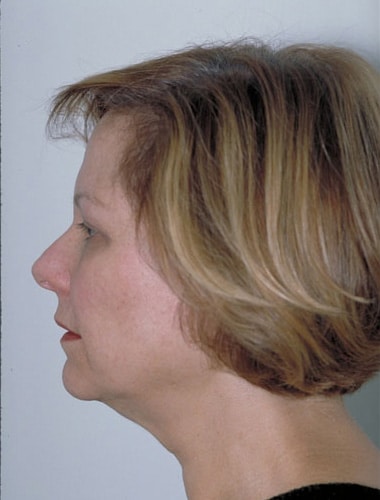 Before Image: Facelift - left-side