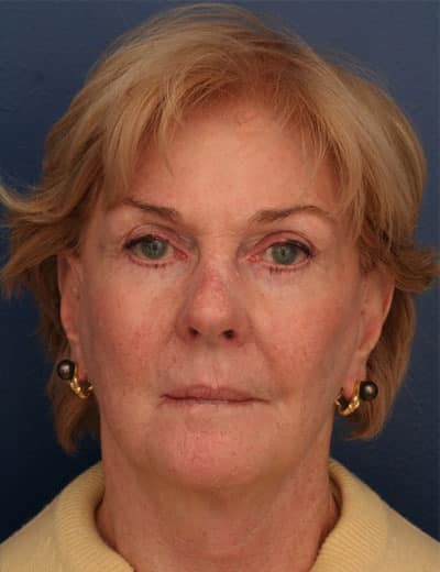 After Image: Facelift - front