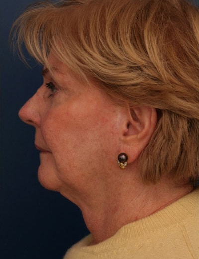 After Image: Facelift - left-side