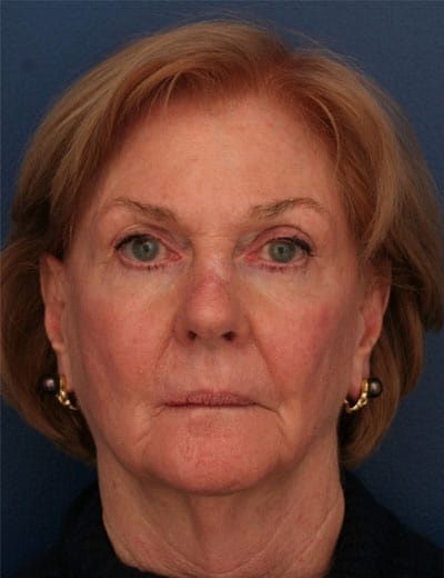 Before Image: Facelift - front
