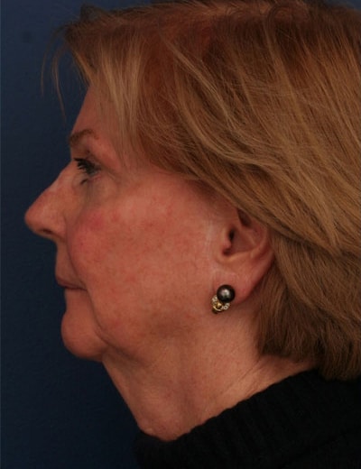 Before Image: Facelift - left-side