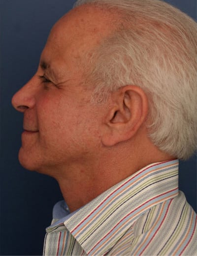 After Image: Facelift - left-side