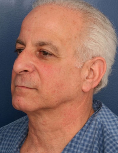 Before Image: Facelift - left-front-oblique