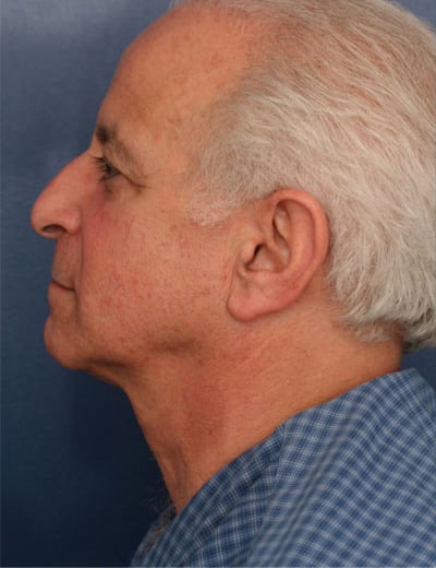 Before Image: Facelift - left-side
