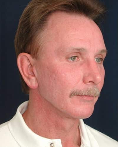 After Image: Facelift - right-front-oblique