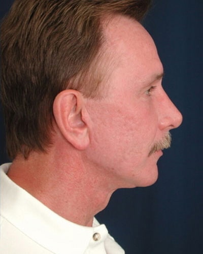 After Image: Facelift - right-side