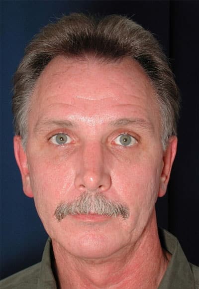 Before Image: Facelift - front